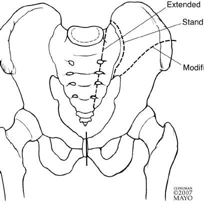 hemipelvectomy female|Hemipelvectomy Procedure .